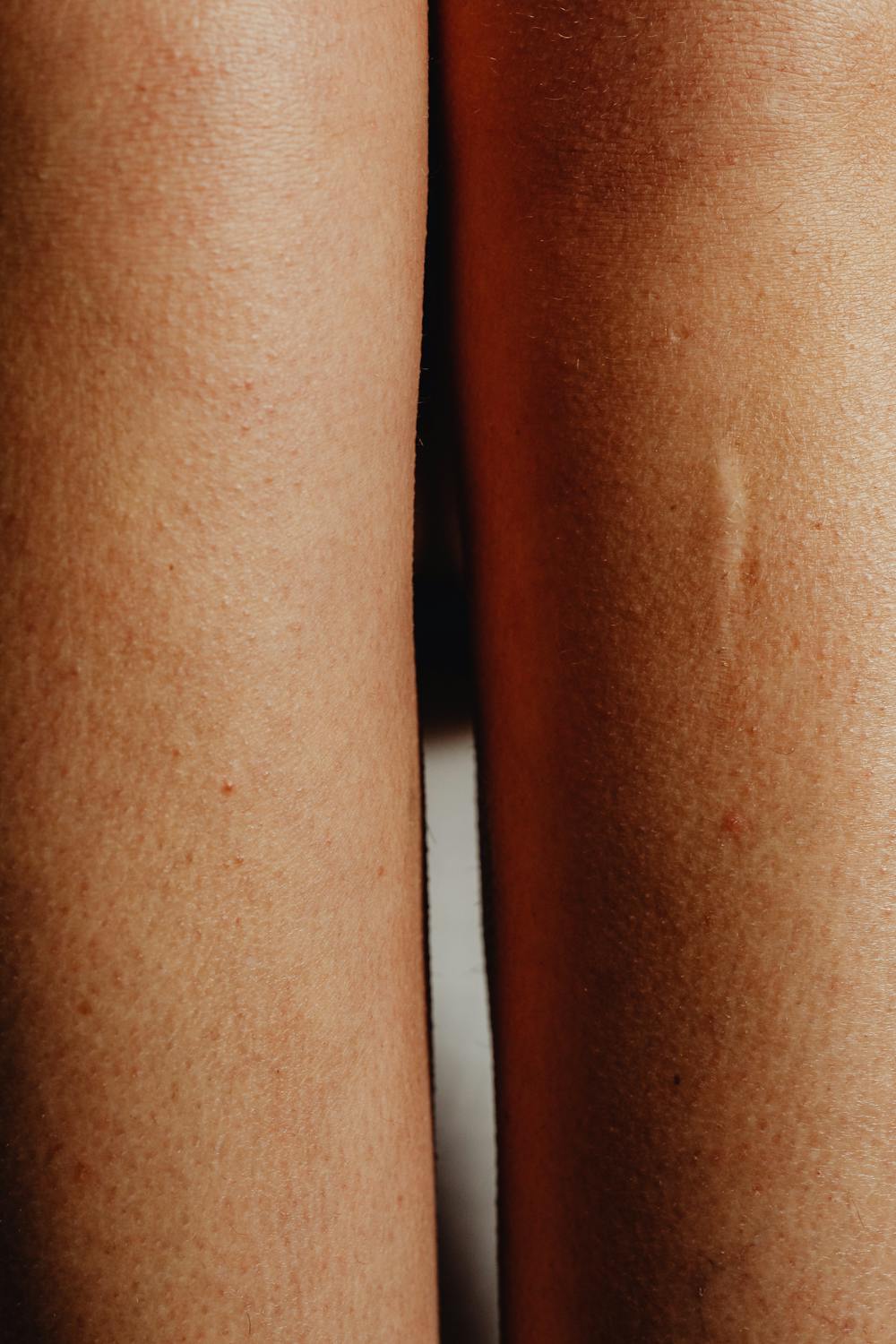 Narben als Lebenslinien – Sinnbild für Stärke und achtsame Healyni Narbenpflege