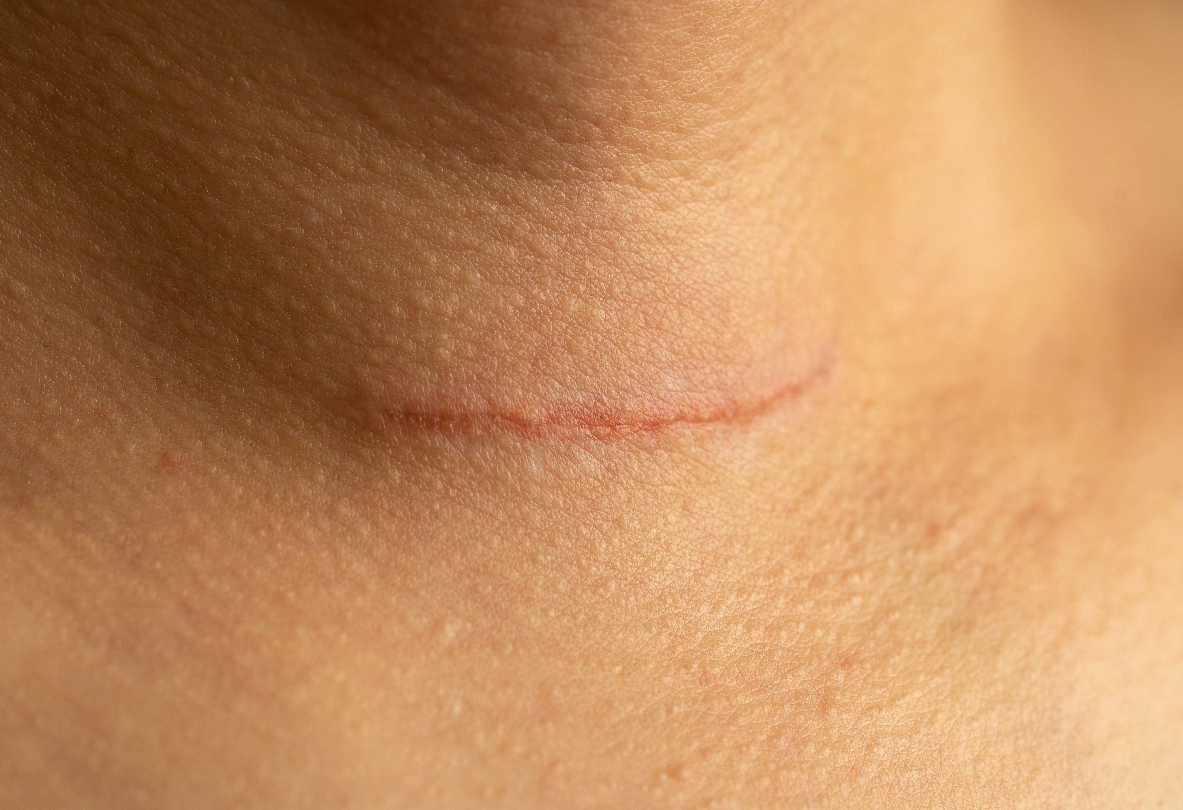 Scar_Care_Healyni_0001.jpg