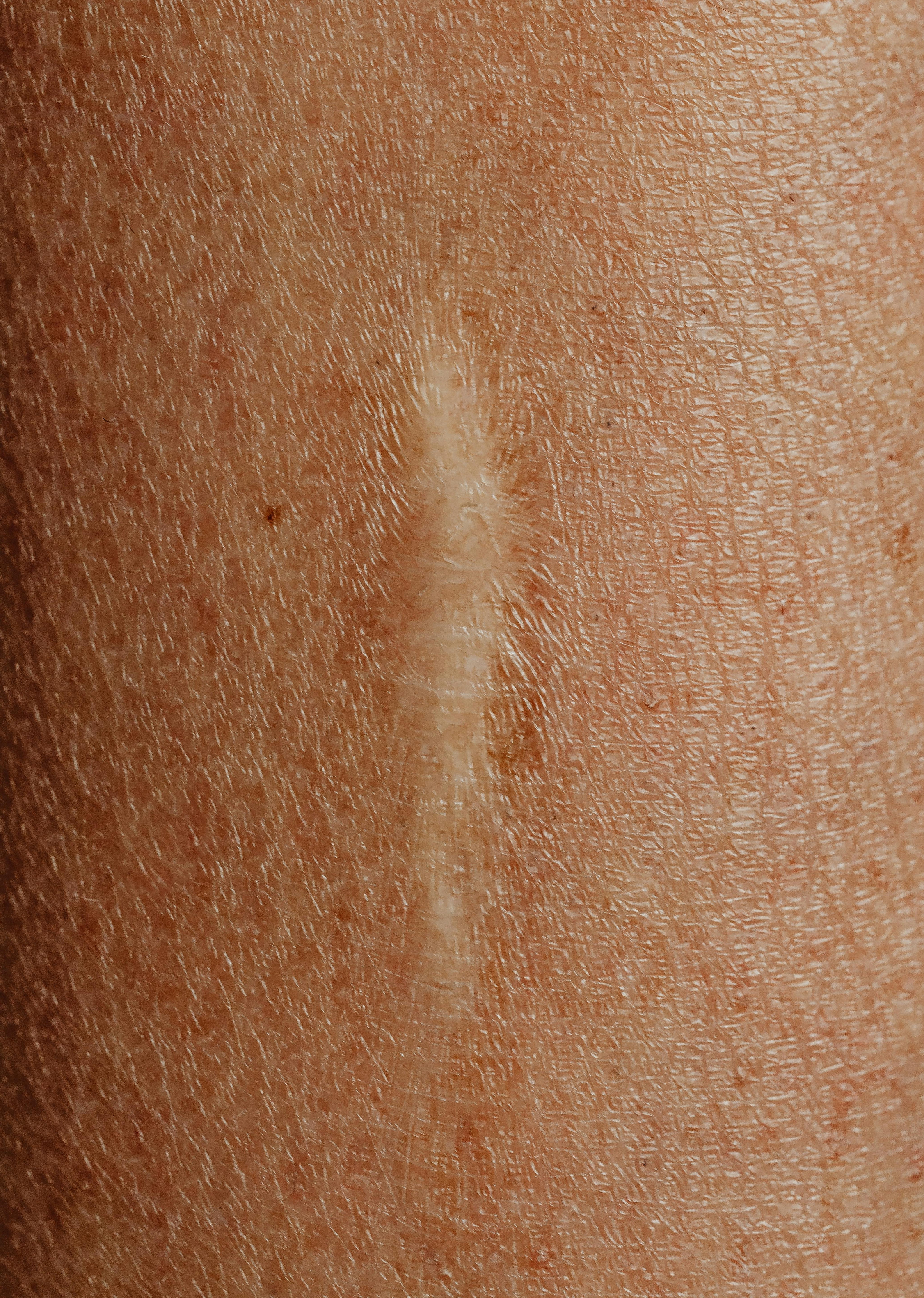Nahaufnahme einer gut verheilten Narbe – Pflegeansatz der Healyni Scar Care Formula